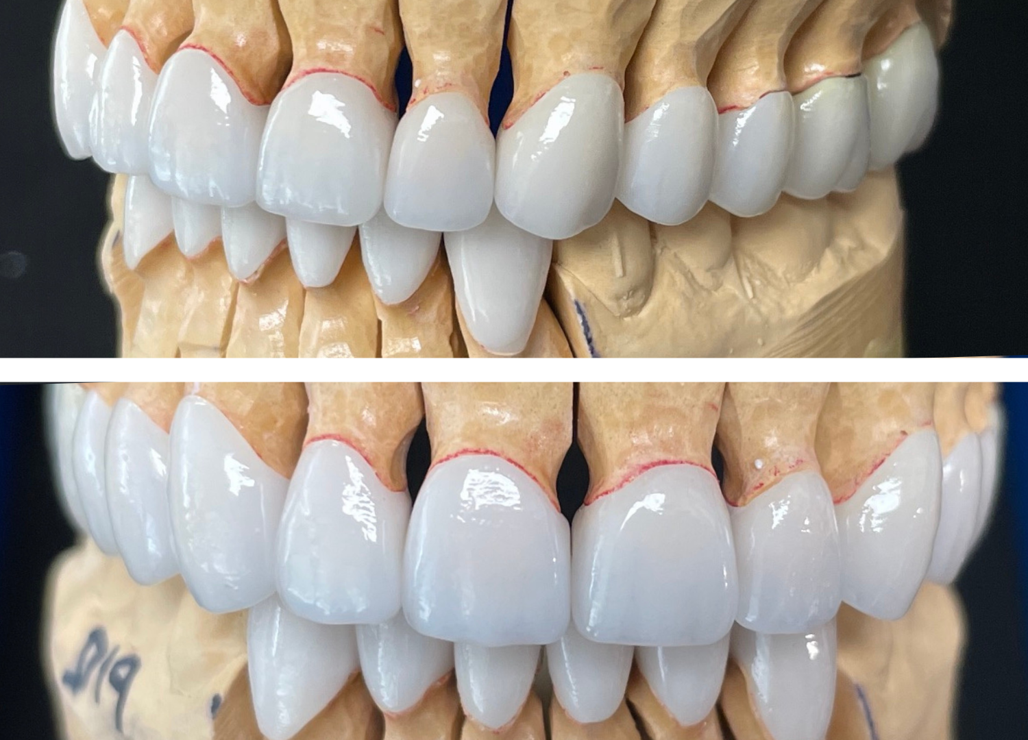 Full Mouth Reconstructions Toronto Dental Lab Dental Laboratory Dental Labs Near Me